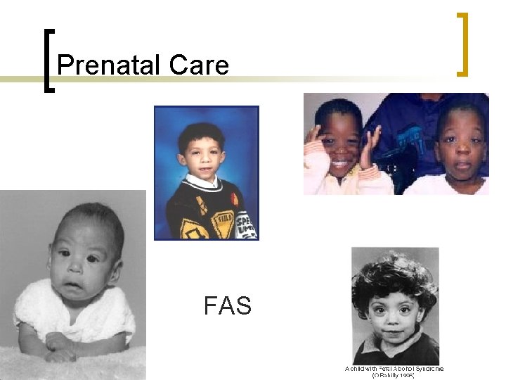 Prenatal Care FAS 