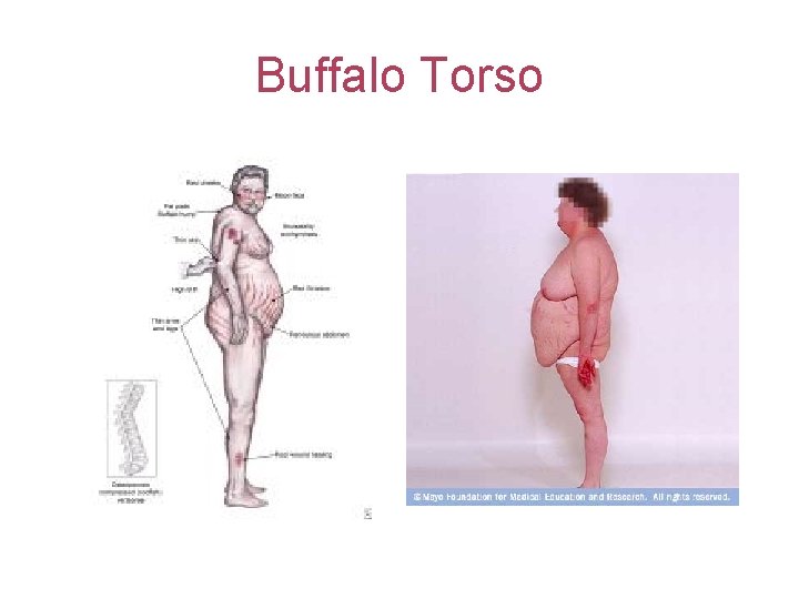 Buffalo Torso 