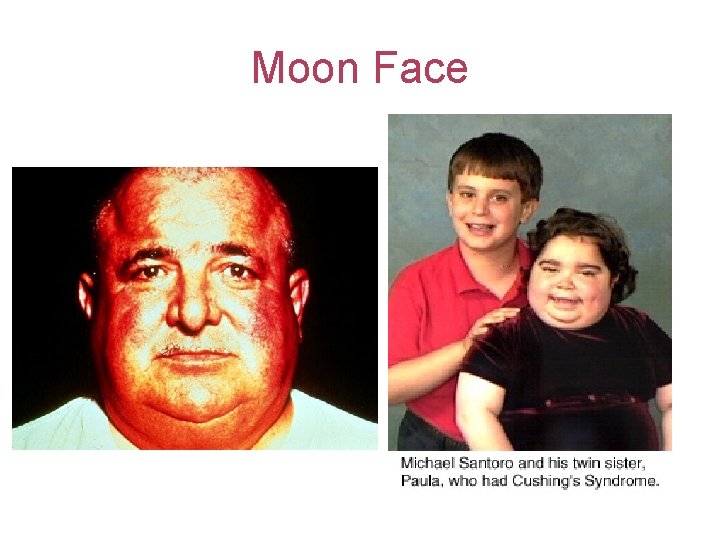 Moon Face 