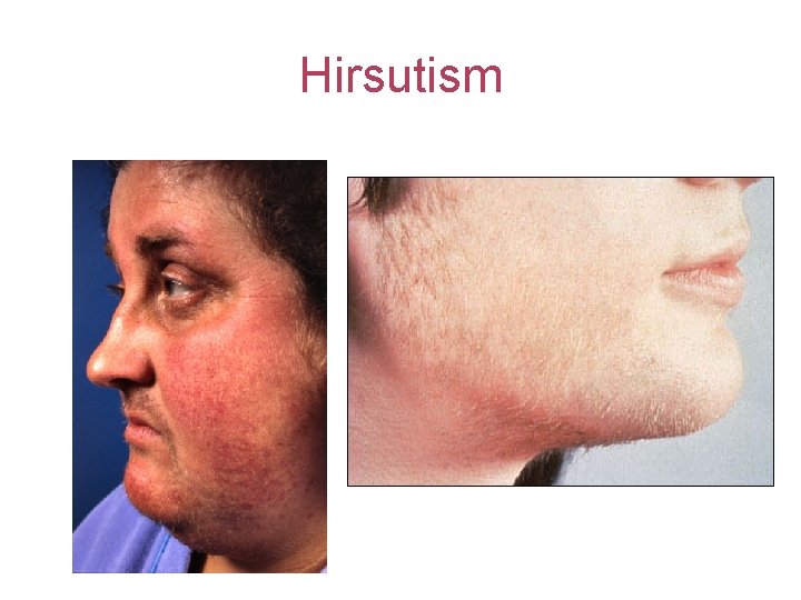 Hirsutism 