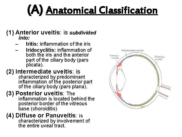 (A) Anatomical Classification (1) Anterior uveitis: is subdivided into: – Iritis: inflammation of the