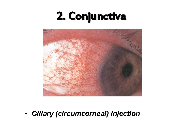 2. Conjunctiva • Ciliary (circumcorneal) injection 