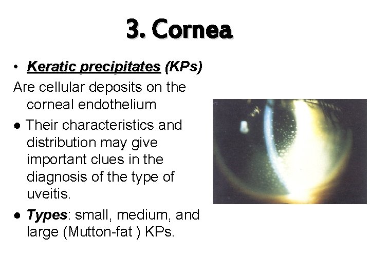 3. Cornea • Keratic precipitates (KPs) Are cellular deposits on the corneal endothelium ●