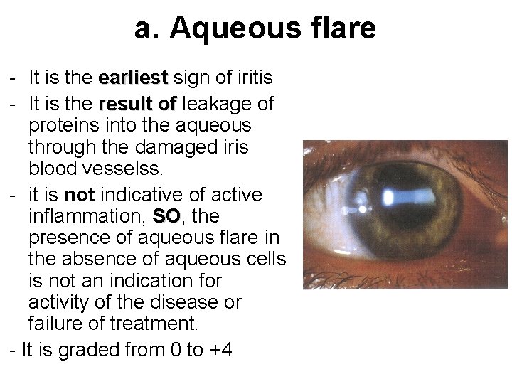 a. Aqueous flare - It is the earliest sign of iritis - It is