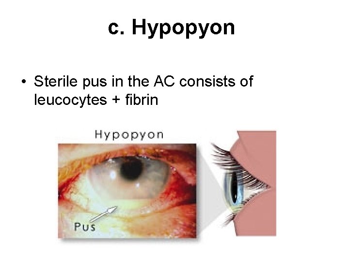 c. Hypopyon • Sterile pus in the AC consists of leucocytes + fibrin 