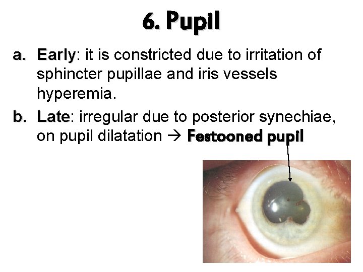 6. Pupil a. Early: Early it is constricted due to irritation of sphincter pupillae