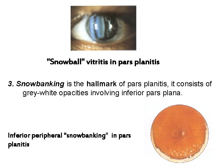 "Snowball" vitritis in pars planitis 3. Snowbanking is the hallmark of pars planitis, it