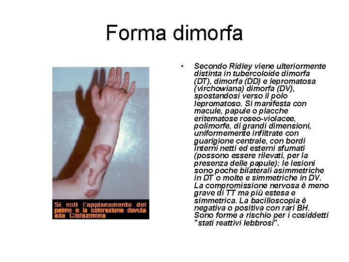 Forma dimorfa • Secondo Ridley viene ulteriormente distinta in tubercoloide dimorfa (DT), dimorfa (DD)