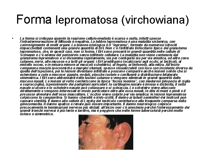 Forma lepromatosa (virchowiana) • La forma si sviluppa quando la reazione cellulo-mediata è scarsa