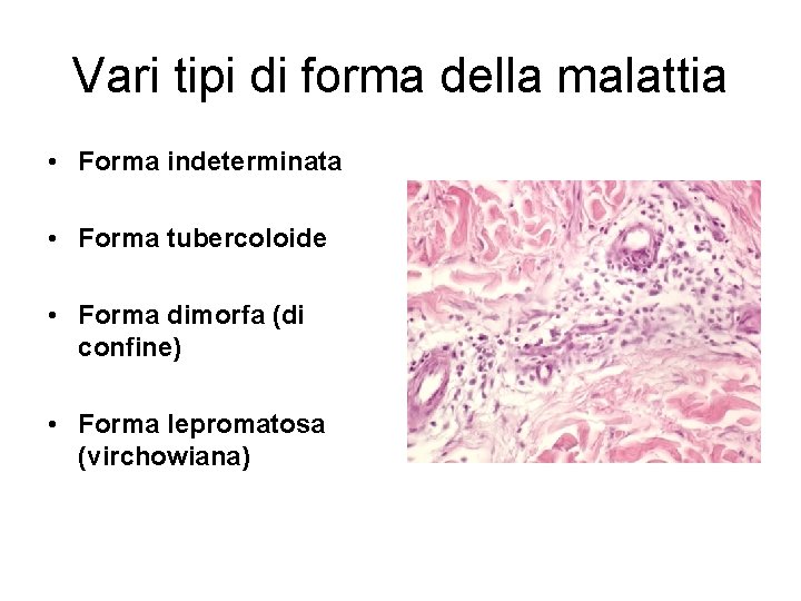 Vari tipi di forma della malattia • Forma indeterminata • Forma tubercoloide • Forma