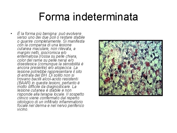 Forma indeterminata • È la forma più benigna: può evolvere verso uno dei due