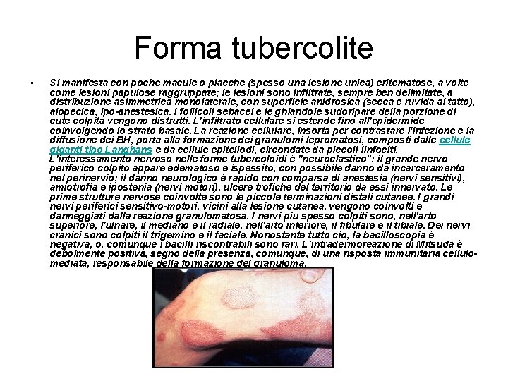Forma tubercolite • Si manifesta con poche macule o placche (spesso una lesione unica)