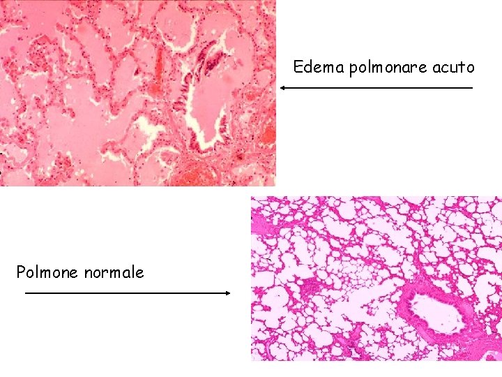 Edema polmonare acuto Polmone normale 