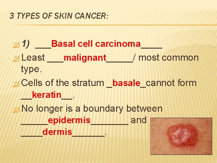 3 TYPES OF SKIN CANCER: 1) ___Basal cell carcinoma____ Least ___malignant_____/ most common type.