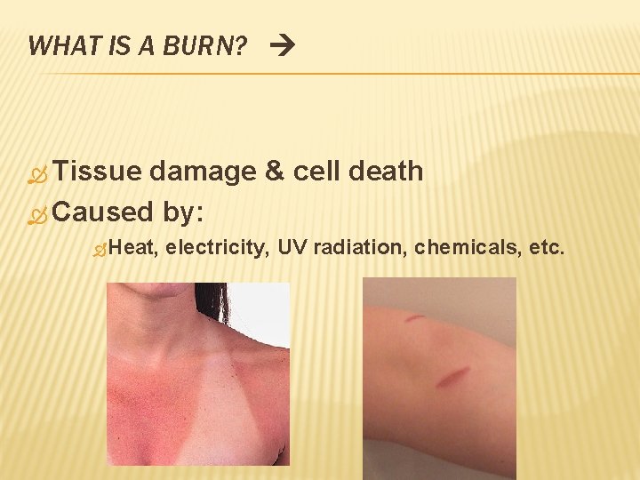 WHAT IS A BURN? Tissue damage & cell death Caused by: Heat, electricity, UV