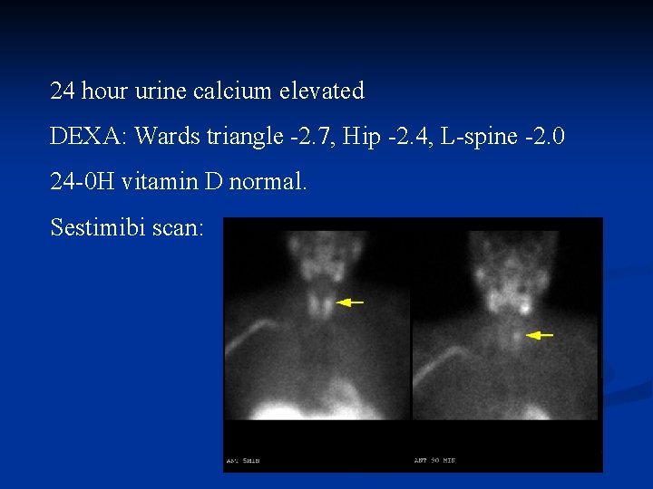24 hour urine calcium elevated DEXA: Wards triangle -2. 7, Hip -2. 4, L-spine