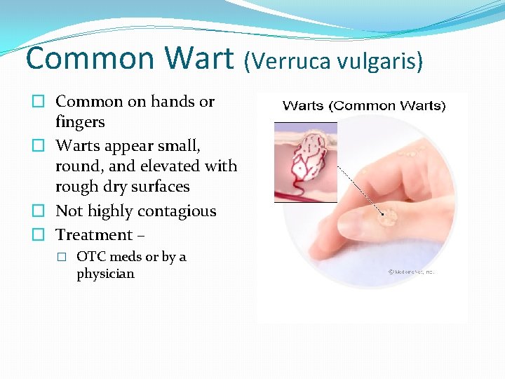 Common Wart (Verruca vulgaris) � Common on hands or fingers � Warts appear small,