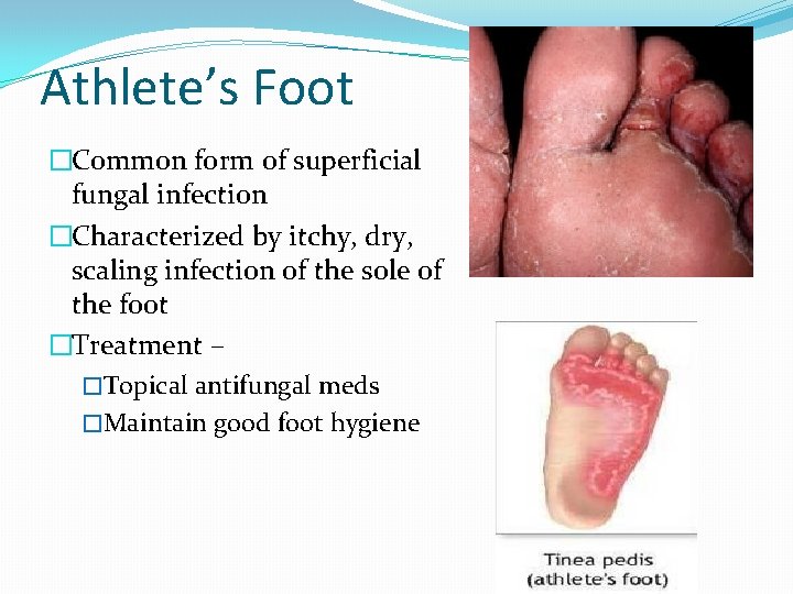 Athlete’s Foot �Common form of superficial fungal infection �Characterized by itchy, dry, scaling infection