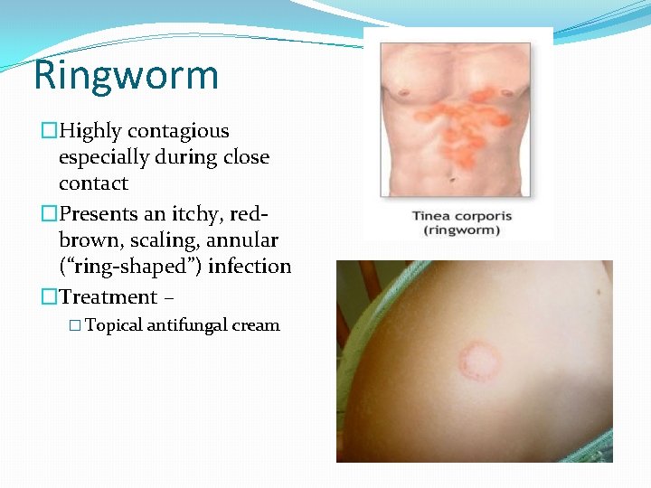 Ringworm �Highly contagious especially during close contact �Presents an itchy, redbrown, scaling, annular (“ring-shaped”)