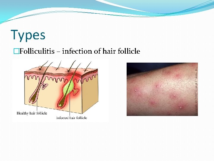 Types �Folliculitis – infection of hair follicle 