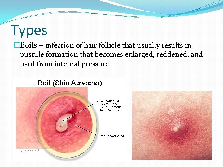 Types �Boils – infection of hair follicle that usually results in pustule formation that
