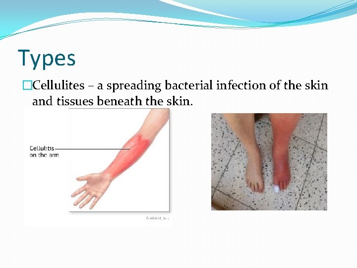 Types �Cellulites – a spreading bacterial infection of the skin and tissues beneath the