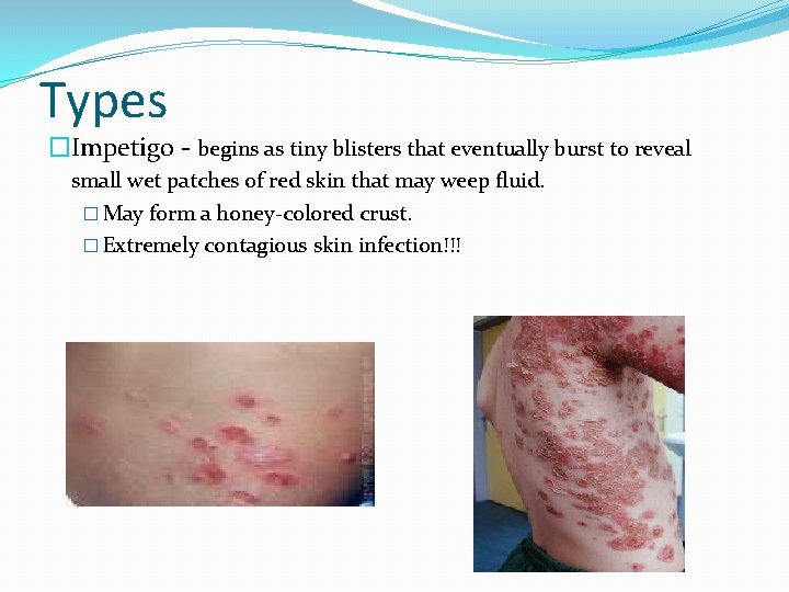 Types �Impetigo - begins as tiny blisters that eventually burst to reveal small wet