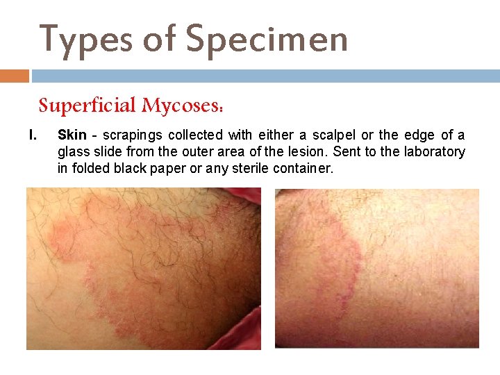 Types of Specimen Superficial Mycoses: I. Skin - scrapings collected with either a scalpel