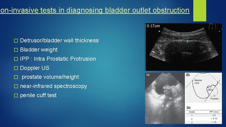 Non-invasive tests in diagnosing bladder outlet obstruction � Detrusor/bladder wall thickness � Bladder weight
