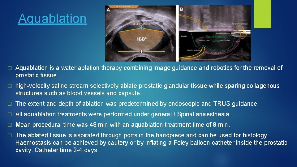 Aquablation � Aquablation is a water ablation therapy combining image guidance and robotics for