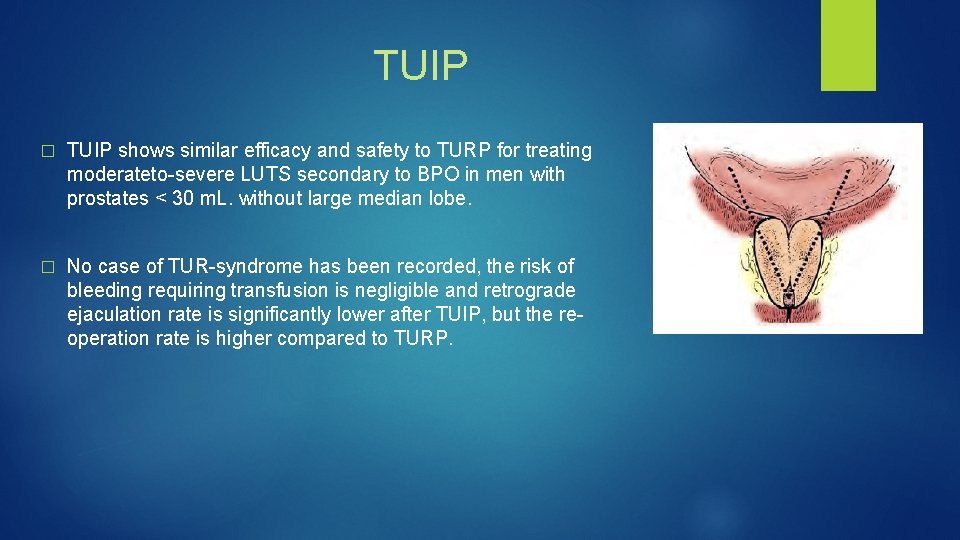 TUIP � TUIP shows similar efficacy and safety to TURP for treating moderateto-severe LUTS