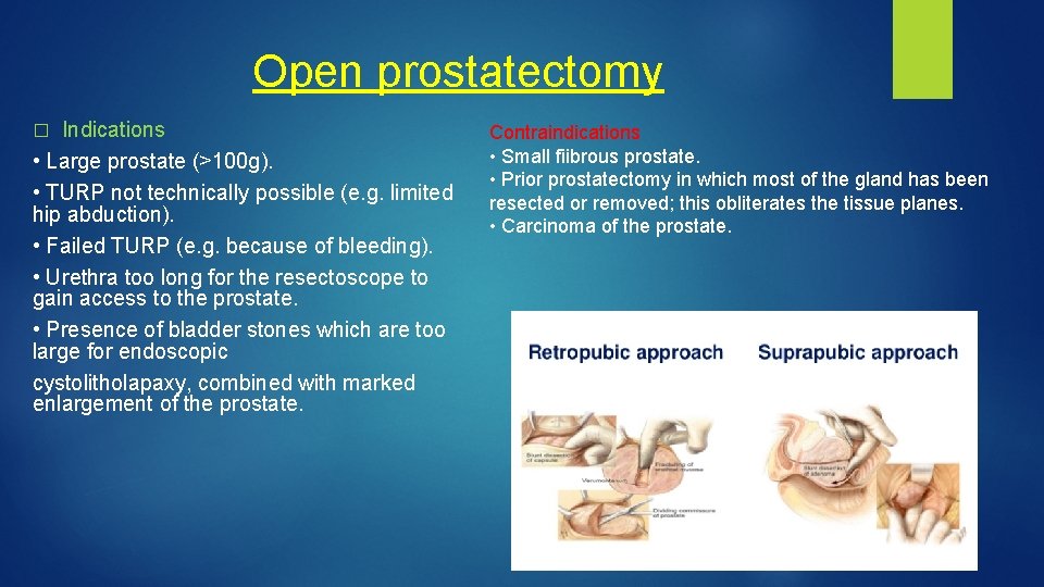 Open prostatectomy Indications • Large prostate (>100 g). • TURP not technically possible (e.