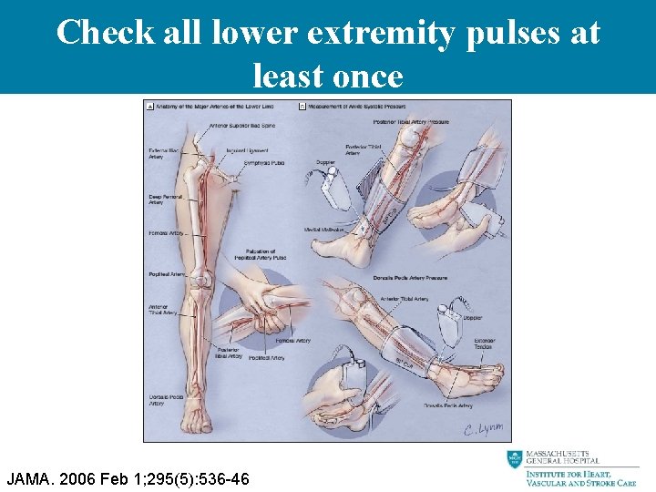 Check all lower extremity pulses at least once JAMA. 2006 Feb 1; 295(5): 536