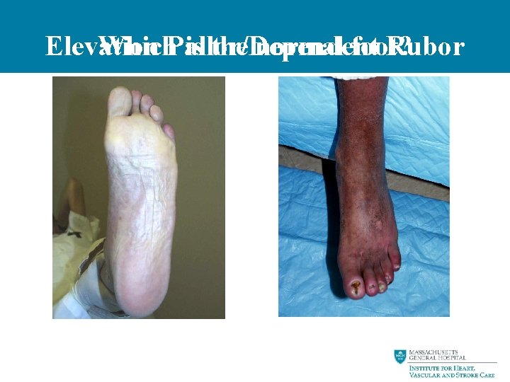 Elevation Which. Pallor/Dependent is the normal foot? Rubor 
