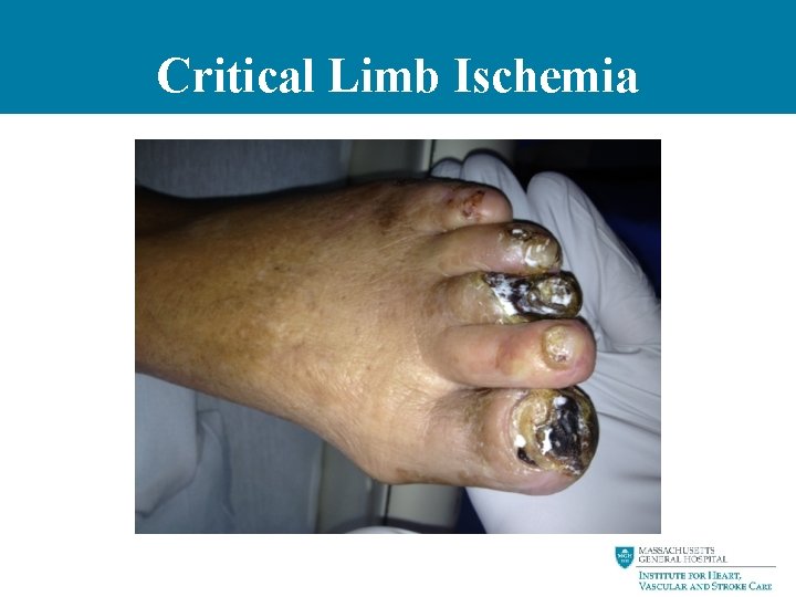 Critical Limb Ischemia 