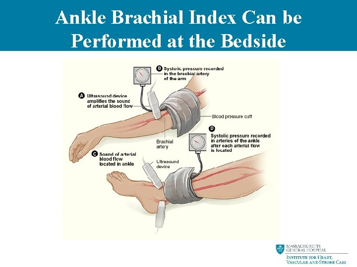 Ankle Brachial Index Can be Performed at the Bedside 