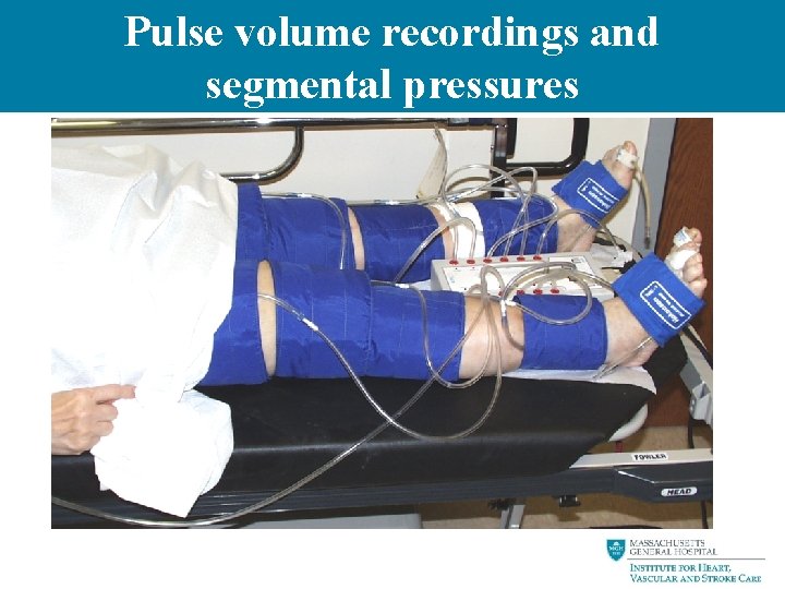Pulse volume recordings and segmental pressures 