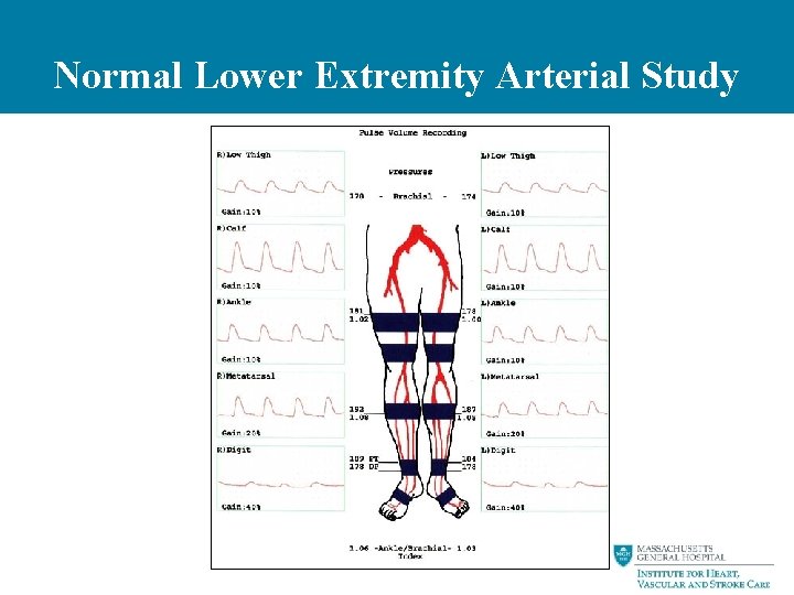 Normal Lower Extremity Arterial Study 