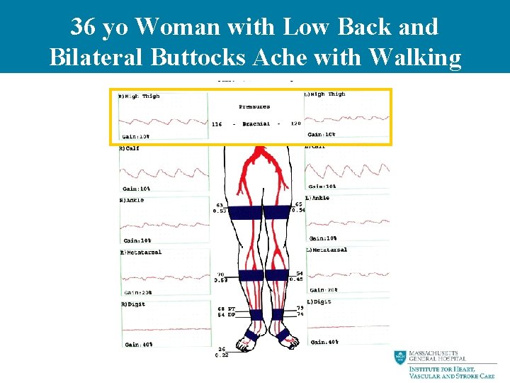 36 yo Woman with Low Back and Bilateral Buttocks Ache with Walking 