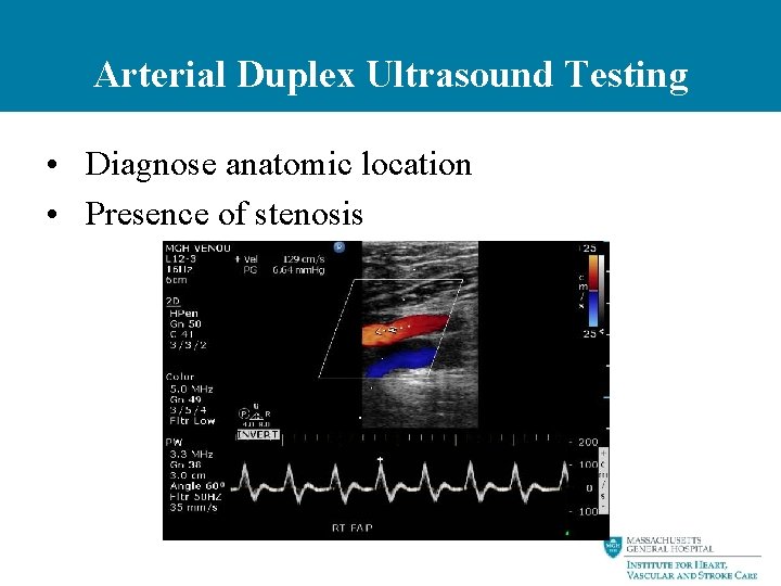 Arterial Duplex Ultrasound Testing • Diagnose anatomic location • Presence of stenosis 