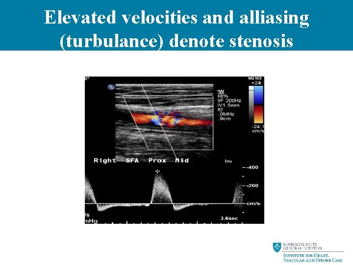Elevated velocities and alliasing (turbulance) denote stenosis 