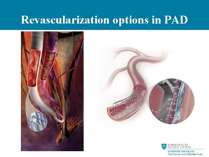 Revascularization options in PAD 
