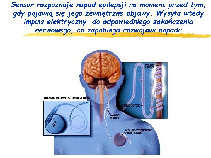 Sensor rozpoznaje napad epilepsji na moment przed tym, gdy pojawią się jego zewnętrzne objawy.