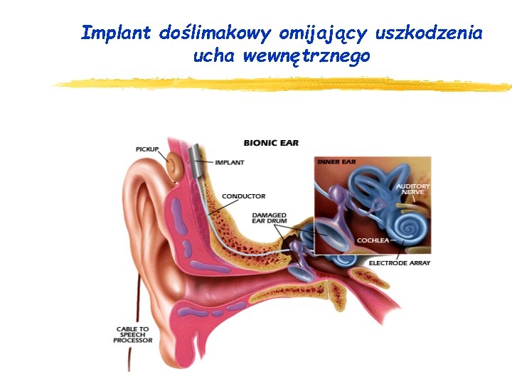 Implant doślimakowy omijający uszkodzenia ucha wewnętrznego 