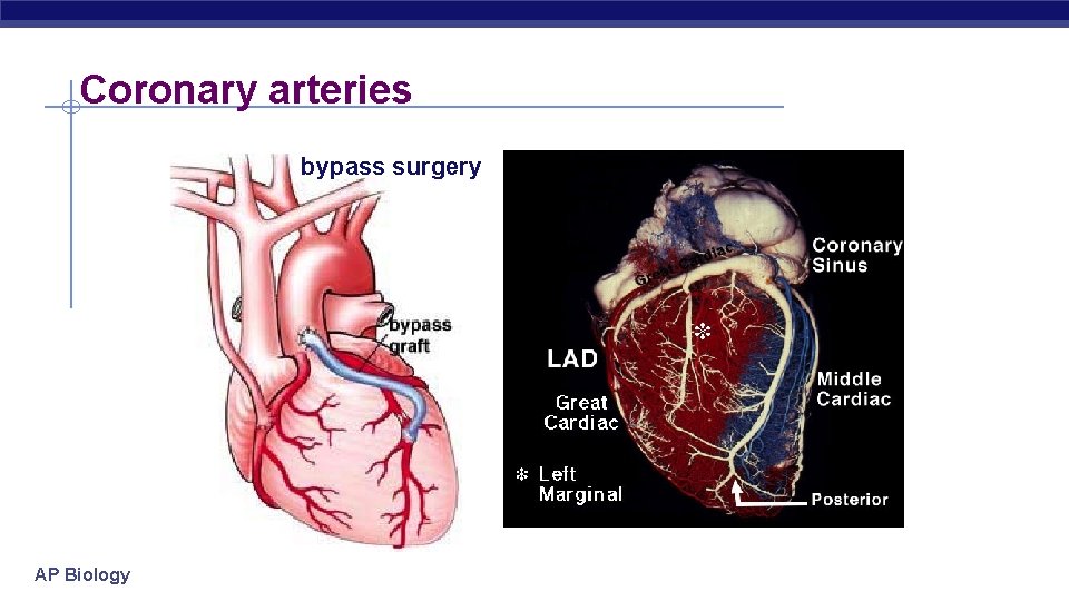 Coronary arteries bypass surgery AP Biology 