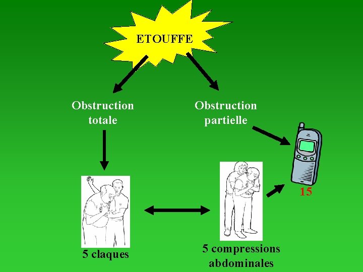 ETOUFFE Obstruction totale Obstruction partielle 15 5 claques 5 compressions abdominales 