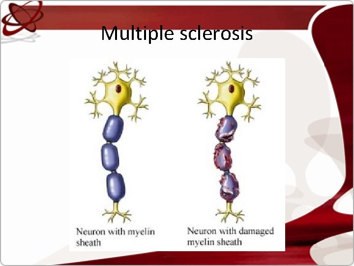 Multiple sclerosis 