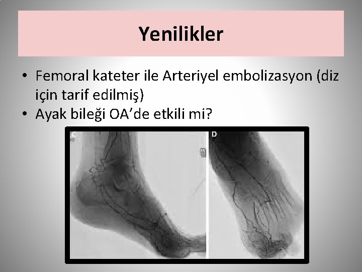 Yenilikler • Femoral kateter ile Arteriyel embolizasyon (diz için tarif edilmiş) • Ayak bileği
