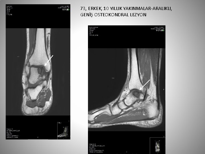 73, ERKEK, 10 YILLIK YAKINMALAR-ARALIKLI, GENİŞ OSTEOKONDRAL LEZYON 