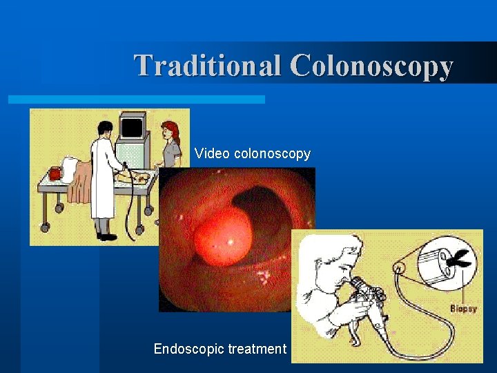 Traditional Colonoscopy Video colonoscopy Endoscopic treatment 